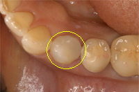 CERECによる詰め物作成例