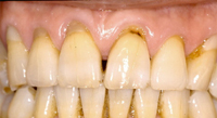 歯周病症例写真（治療前）