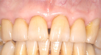 歯周病症例写真（治療後）