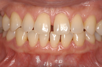【治療前】CERECによるすきっ歯のセラミック治療