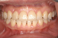 【治療後】CERECによるすきっ歯のセラミック治療